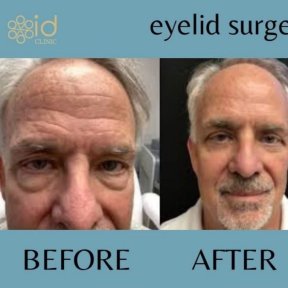 Before and after upper eyelid surgery results at ID Clinic Bangkok, rejuvenated eye area