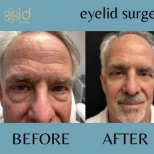 Before and after upper eyelid surgery results at ID Clinic Bangkok, rejuvenated eye area