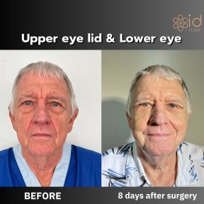 Before and after upper and lower eyelid surgery results at ID Clinic Bangkok, 8 days post-op
