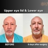 Before and after upper and lower eyelid surgery results at ID Clinic Bangkok, 8 days post-op