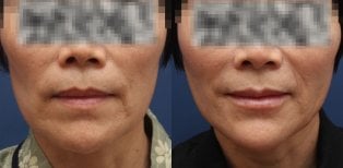 Resultados de lifting facial antes y después en HERSHE Plastic Surgery Korea, rejuvenecimiento