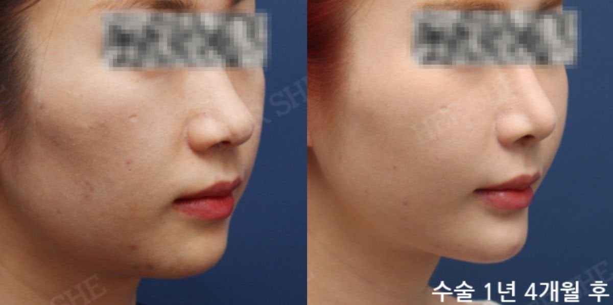 Facelift before and after results at HERSHE Plastic Surgery Korea, visible facial contour lift