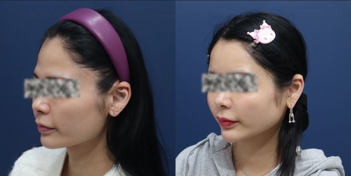 Facelift before and after results at HERSHE Plastic Surgery Korea, visible facial contour lift