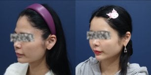 Resultados de lifting facial antes y después en HERSHE Plastic Surgery Korea, contorno mejorado