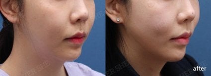 Resultados de lifting facial antes y después en HERSHE Plastic Surgery Korea, contorno mejorado