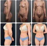 نتائج شد البطن والشفط قبل وبعد في Yurchenko Plastic Surgery Team Kyiv