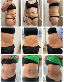 نتائج شد البطن والشفط قبل وبعد في Yurchenko Plastic Surgery Team Kyiv