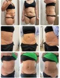 نتائج شد البطن والشفط قبل وبعد في Yurchenko Plastic Surgery Team Kyiv