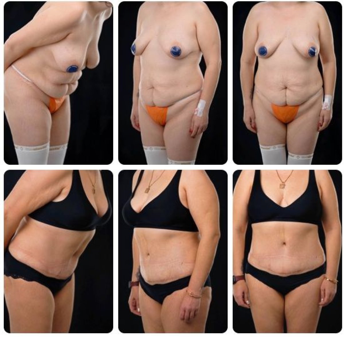نتائج شد البطن والشفط قبل وبعد في Yurchenko Plastic Surgery Team Kyiv