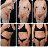 نتائج شد البطن والشفط قبل وبعد في Yurchenko Plastic Surgery Team Kyiv