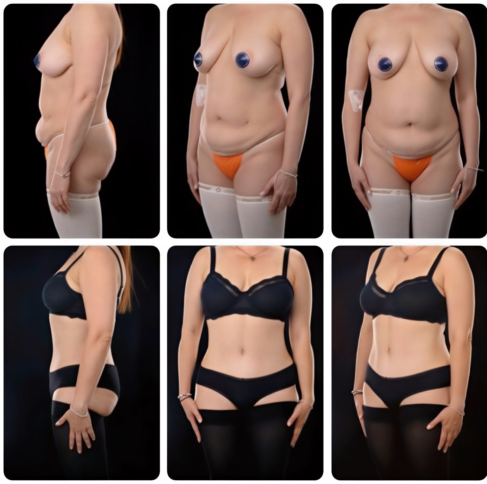 نتائج شد البطن والشفط قبل وبعد في Yurchenko Plastic Surgery Team Kyiv