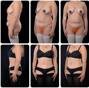 نتائج شد البطن والشفط قبل وبعد في Yurchenko Plastic Surgery Team Kyiv