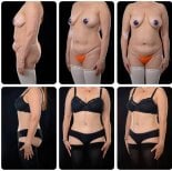 نتائج شد البطن والشفط قبل وبعد في Yurchenko Plastic Surgery Team Kyiv