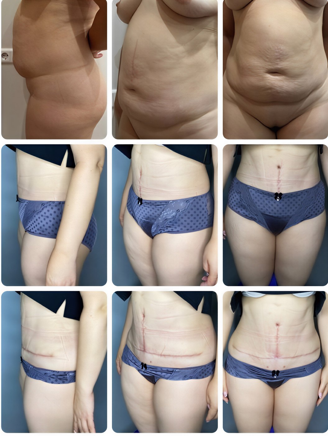 Resultados antes y después de abdominoplastia y liposucción en Yurchenko Plastic Surgery Team Kyiv