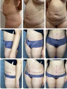نتائج شد البطن والشفط قبل وبعد في Yurchenko Plastic Surgery Team Kyiv