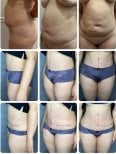 نتائج شد البطن والشفط قبل وبعد في Yurchenko Plastic Surgery Team Kyiv