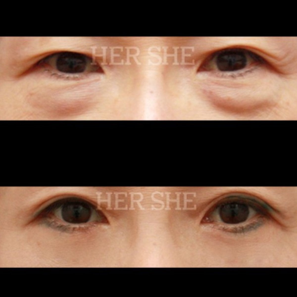 نتائج رأب الجفن السفلي قبل وبعد في HERSHE Plastic Surgery Korea