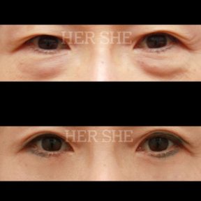 Результаты блефаропластики нижних век до и после в HERSHE Plastic Surgery Korea