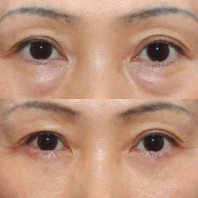 Результаты нижней блефаропластики век до и после в HERSHE Plastic Surgery Korea