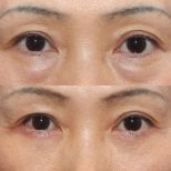 Результаты нижней блефаропластики век до и после в HERSHE Plastic Surgery Korea