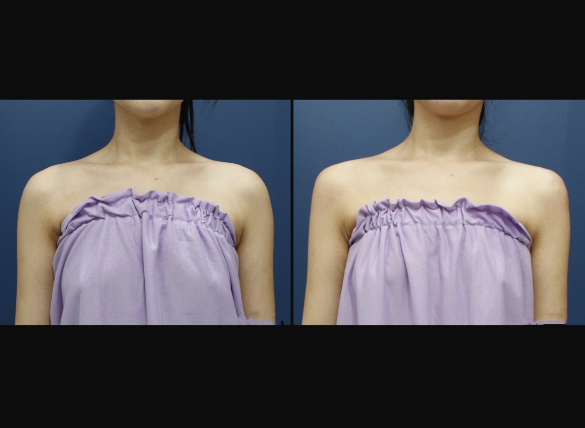 Antes y después de rellenos de ácido hialurónico en hombros en HERSHE Plastic Surgery Korea