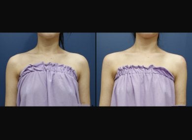 Before and after hyaluronic acid fillers for shoulder contour at HERSHE Plastic Surgery Korea