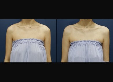 Before and after hyaluronic acid fillers for shoulder contouring at HERSHE Plastic Surgery Korea