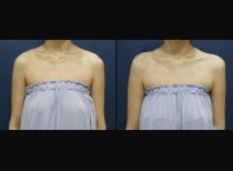 Before and after hyaluronic acid fillers for shoulder contouring at HERSHE Plastic Surgery Korea