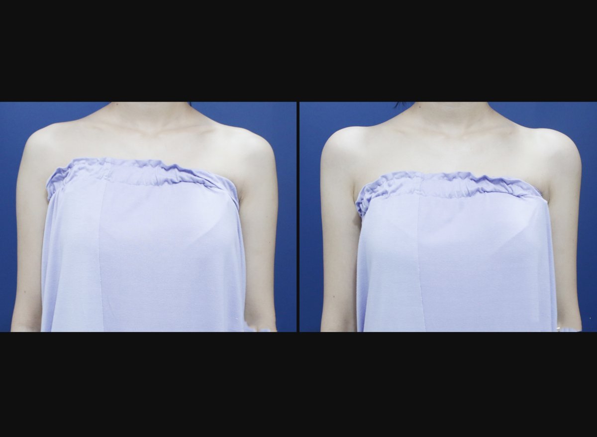 Resultados antes y después de rellenos de ácido hialurónico en hombros en HERSHE Plastic Surgery Korea