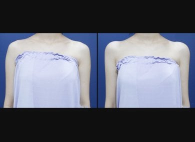 Before and after hyaluronic acid fillers for shoulder contouring at HERSHE Plastic Surgery Korea