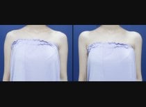 Before and after hyaluronic acid fillers for shoulder contouring at HERSHE Plastic Surgery Korea