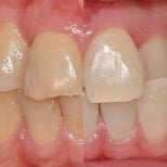Before and after tooth whitening results at Yonsei JW Dental Clinic, visibly brighter teeth