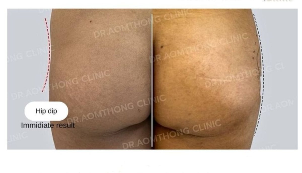 Vorher-nachher-Ergebnis der Hip-Dip-Korrektur mit Fillern bei Doctor Aomthong Clinic