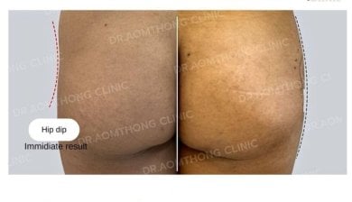 Avant/après correction des creux des hanches par fillers chez Doctor Aomthong Clinic - résultat visible
