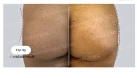 Avant/après correction des creux des hanches par fillers chez Doctor Aomthong Clinic - résultat visible