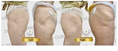 Résultats avant et après injection de fillers aux cuisses à Doctor Aomthong Clinic - Center For Women