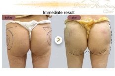 Résultat avant et après injection de fillers fessiers à Doctor Aomthong Clinic - Center For Women