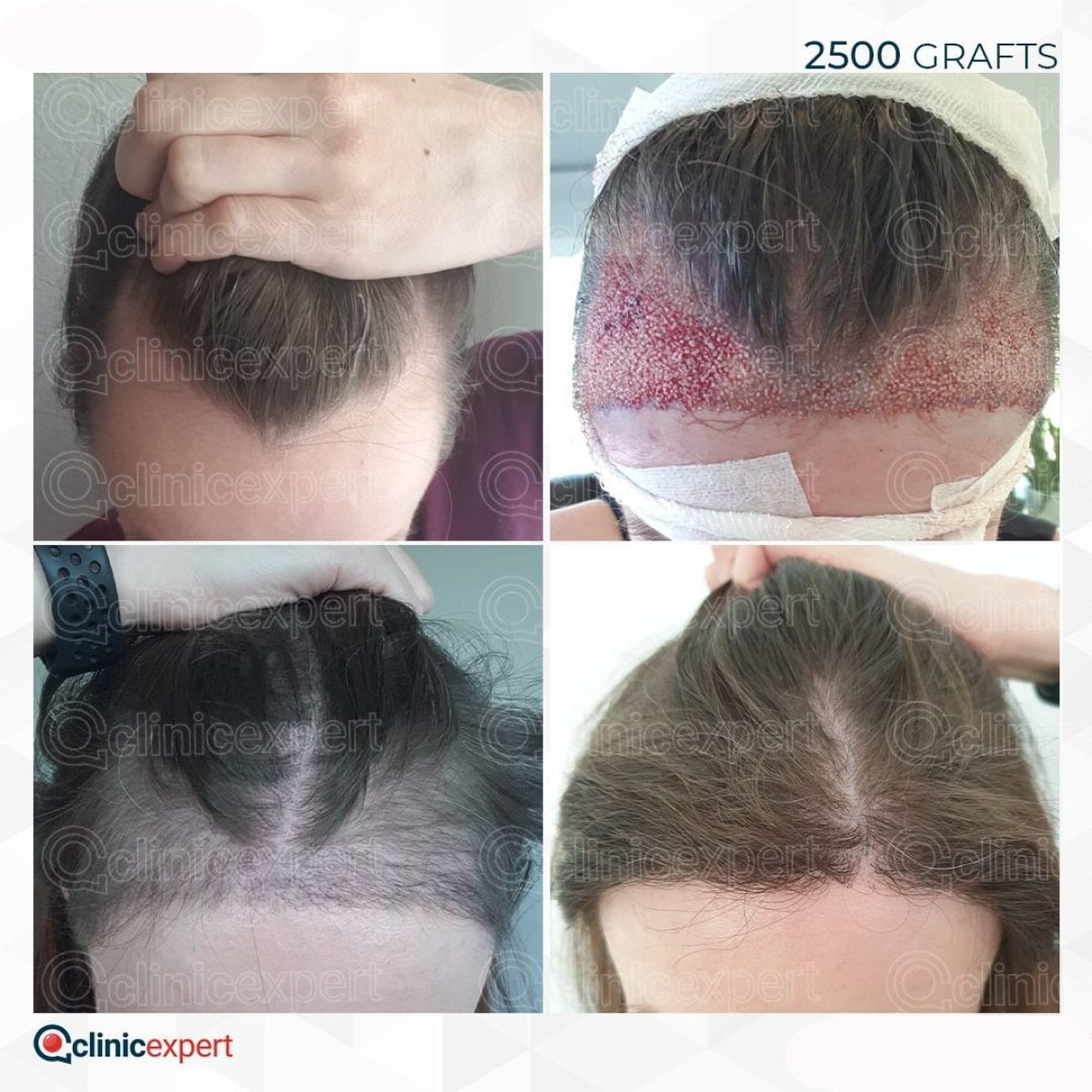 نتائج زراعة الشعر للنساء في CE International Hospital، 2500 طعم