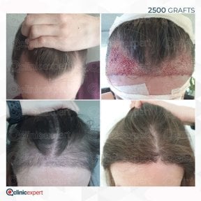 Ergebnisse der Haartransplantation bei Frauen in CE International Hospital, 2500 Grafts