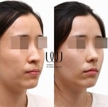 نتائج عملية تجميل الأنف قبل وبعد في عيادة وونجين، تحسين شكل الأنف