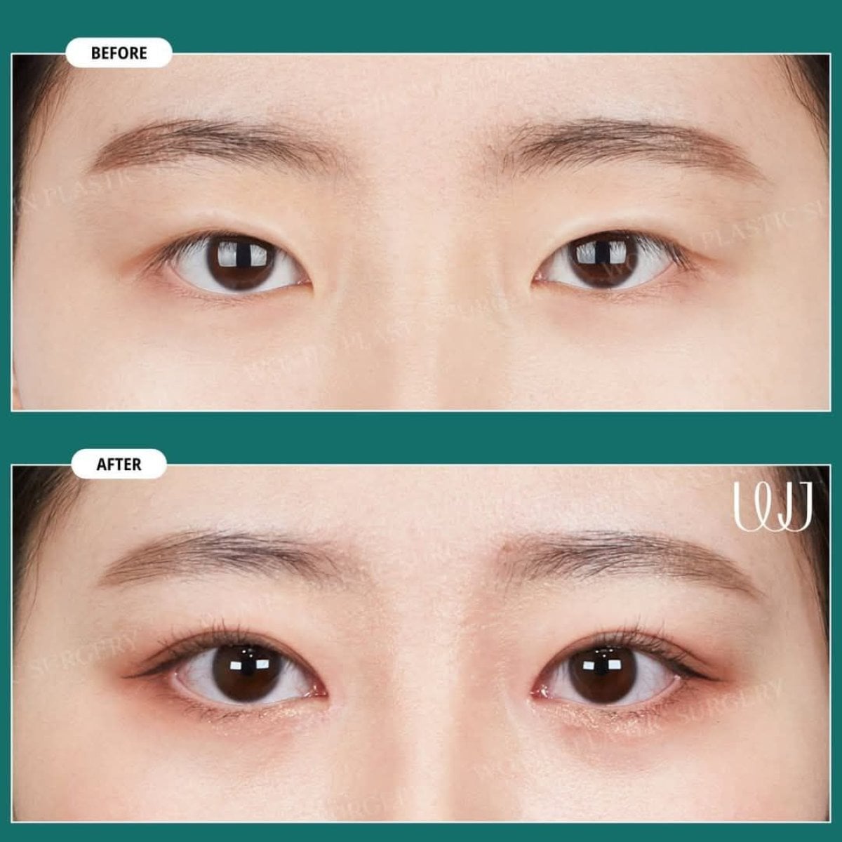 Resultados antes y después de cirugía de doble párpado en Wonjin Plastic Surgery Clinic