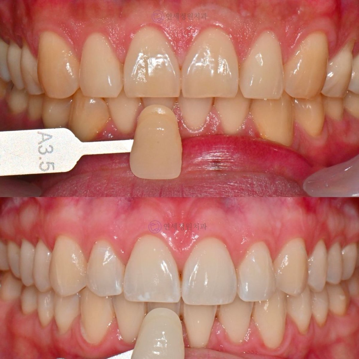 Resultados de blanqueamiento dental antes y después en Yonsei JW Dental Clinic, sonrisa más blanca