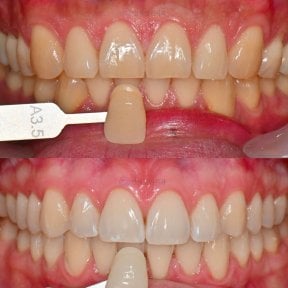 Before and after tooth whitening results at Yonsei JW Dental Clinic, visibly brighter smile