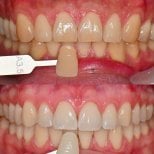 Before and after tooth whitening results at Yonsei JW Dental Clinic, visibly brighter smile