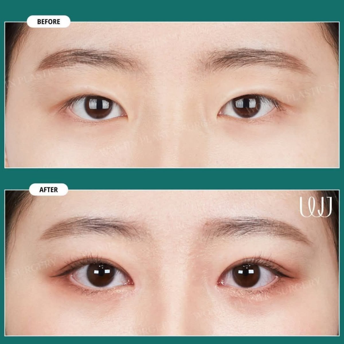 blepharoplasty korea