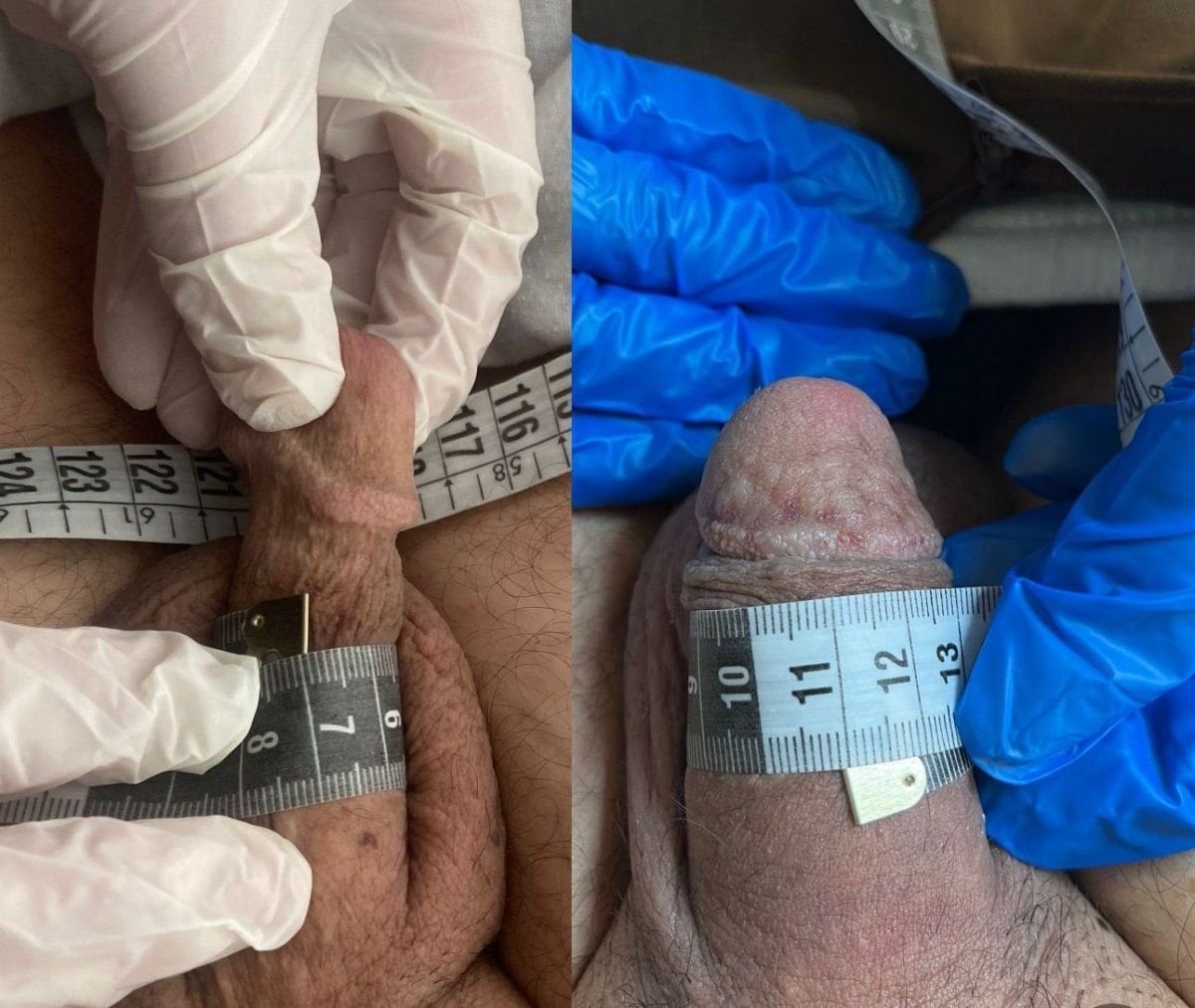 نتائج قبل وبعد جراحة زرع القضيب في Uroaesthetic، زيادة في المحيط