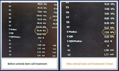 Before and after arterial stem cell treatment results at RE:YOUTH, improved kPa values shown