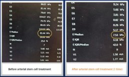 Before and after arterial stem cell treatment results at RE:YOUTH, improved kPa values shown