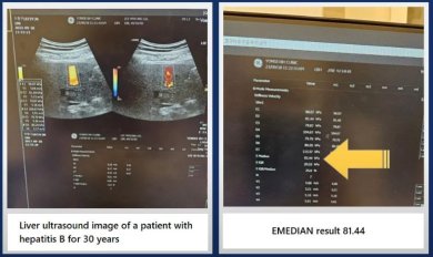 Liver ultrasound and EMEDIAN result for hepatitis B patient at RE:YOUTH (YONSEI BH Arterial Stemcell Clinic)