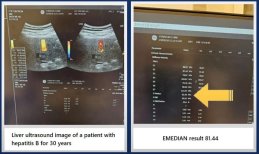 Liver ultrasound and EMEDIAN result for hepatitis B patient at RE:YOUTH (YONSEI BH Arterial Stemcell Clinic)